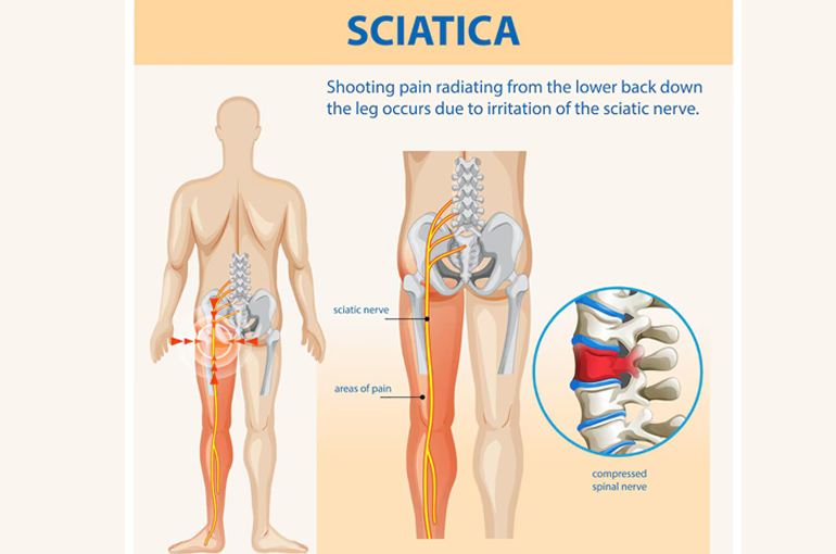 Sciatica Relapse Dr Tushar Kant - Senior Consultant, Neurosurgery dept